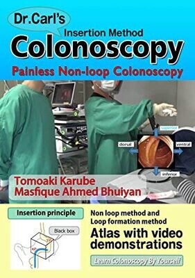 Dr. Carl&#39;s Colonoscopy insertion method