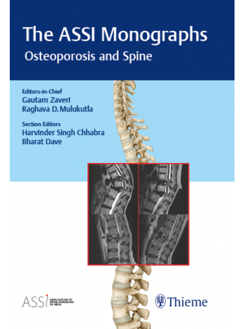 The ASSI Monographs Osteoporosis and Spine