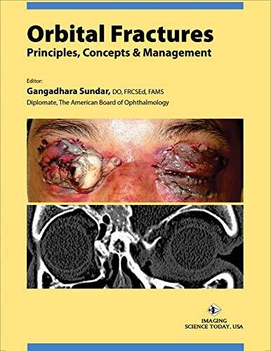 Orbital Fractures: Principles, Concepts &amp; Managements