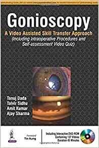 Gonioscopy: A Video Assisted Skill Transfer Approach