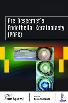 Pre-Descemet’s Endothelial Keratoplasty (PDEK) 1st Edition