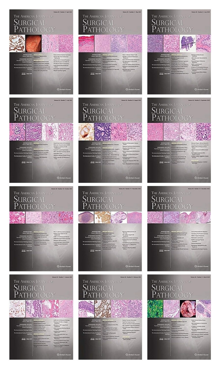 American Journal of Surgical Pathology Full Latest Archives of 2022