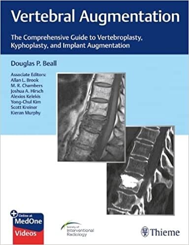Vertebral Augmentation: The Comprehensive Guide to Vertebroplasty, Kyphoplasty, and Implant Augmentation 1st Edición (EPUB)