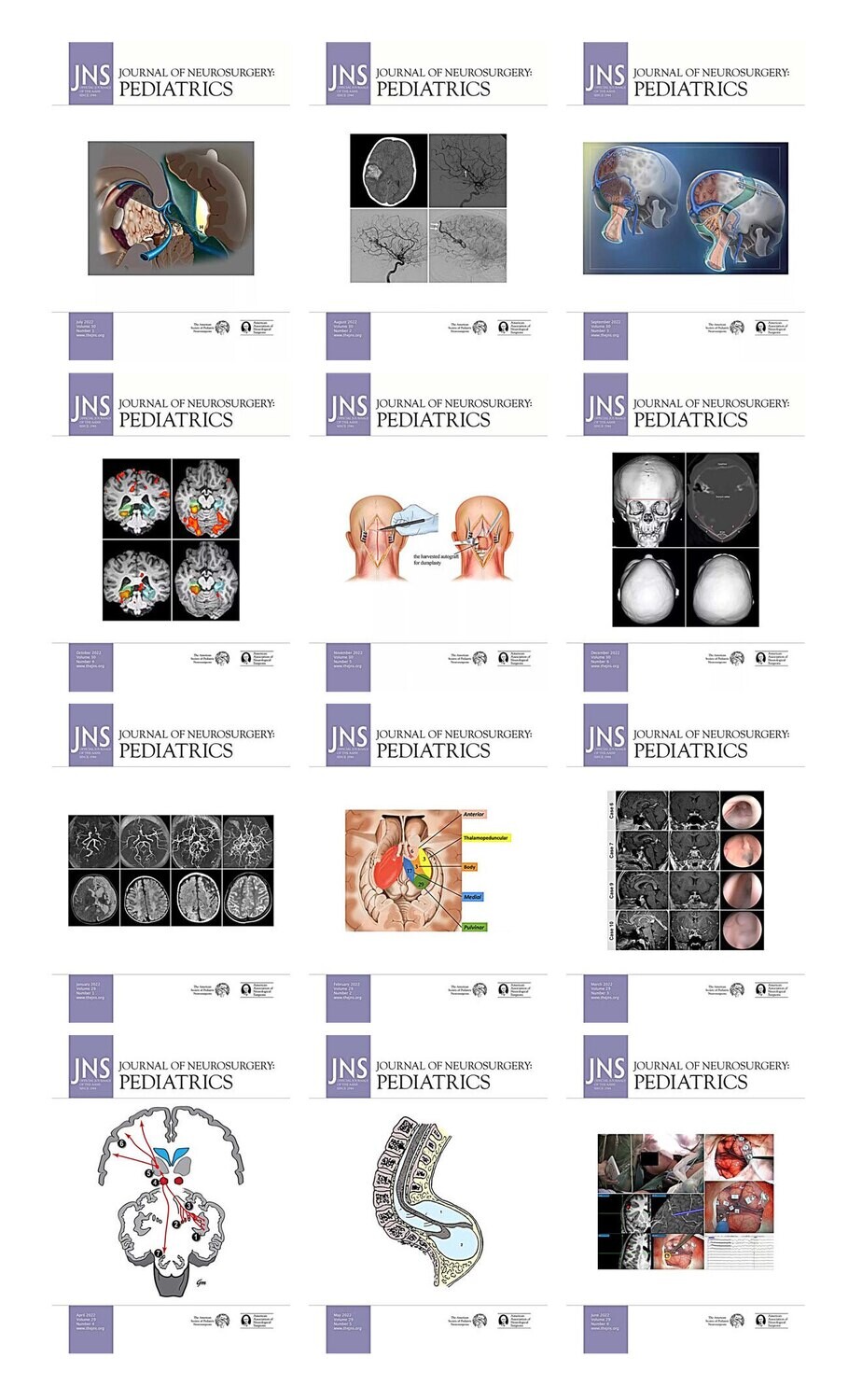 Journal of Neurosurgery: Pediatrics 2022