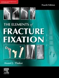 The elements of fracture fixation, 4e