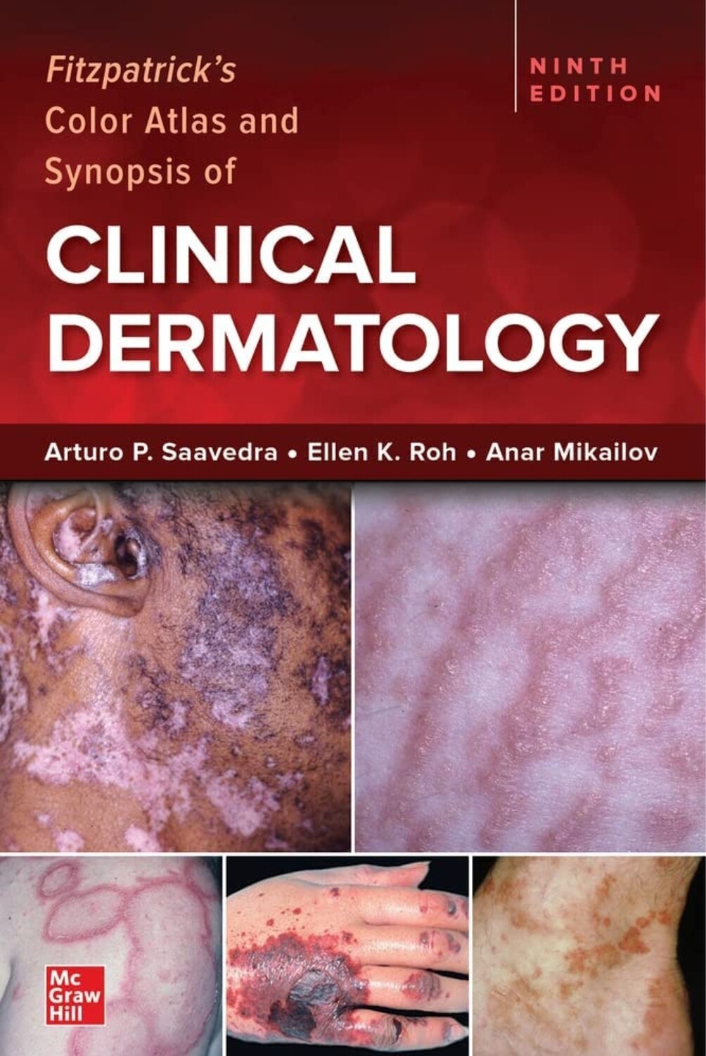 Fitzpatrick&#39;s Color Atlas and Synopsis of Clinical Dermatology 9th Edition 2023