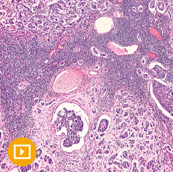 Breast Pathology 2023 (CME VIDEOS)