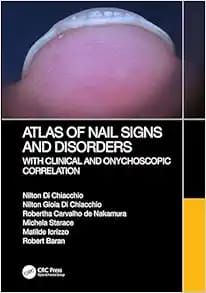 Atlas of Nail Signs and Disorders with Clinical and Onychoscopic Correlation