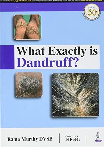 What Exactly is Dandruff