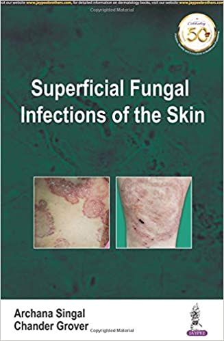 Superficial Fungal Infections of the Skin