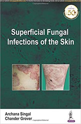 Superficial Fungal Infections of the Skin