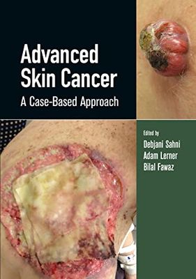 Advanced Skin Cancer: A Case-Based Approach