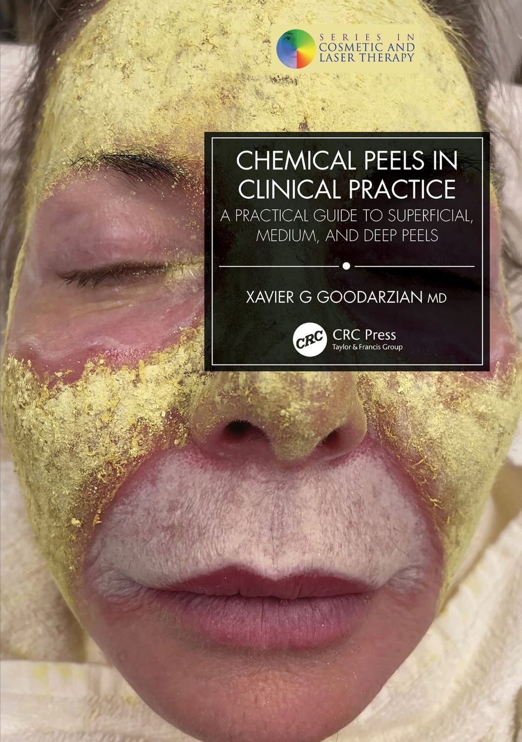 Chemical Peels In Clinical Practice