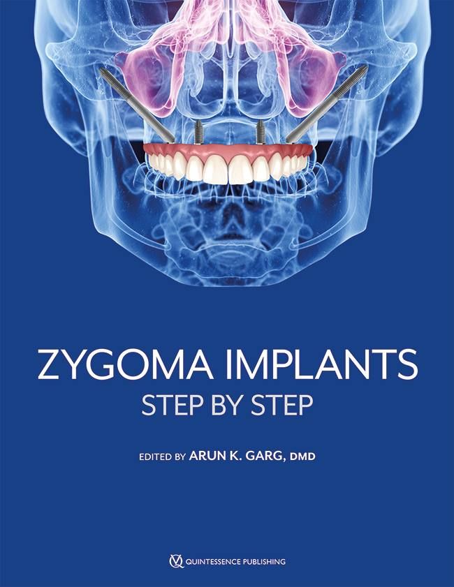 Zygoma Implants: Step By Step