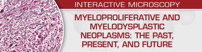 Myeloproliferative and Myelodysplastic Neoplasms: The Past, Present, and Future – USCAP (Videos)
