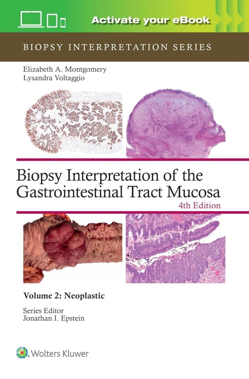 Biopsy Interpretation of the Gastrointestinal Tract Mucosa Volume 2: Neoplastic (Biopsy Interpretation Series) 2024