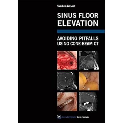 Sinus Floor Elevation: Avoiding Pitfalls Using Cone-beam CT