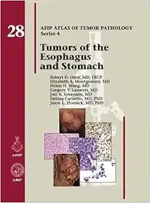 Tumors of the Esophagus