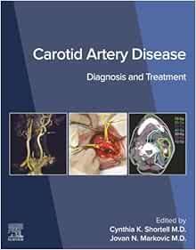 Carotid Artery Disease: Diagnosis and Treatment