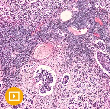 Breast Pathology Oakstone CME's Masters of Pathology Series Video Course / Lectures 2023