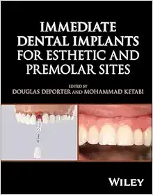 Immediate Dental Implants for Esthetic and Premolar Sites (Original PDF from Publisher)