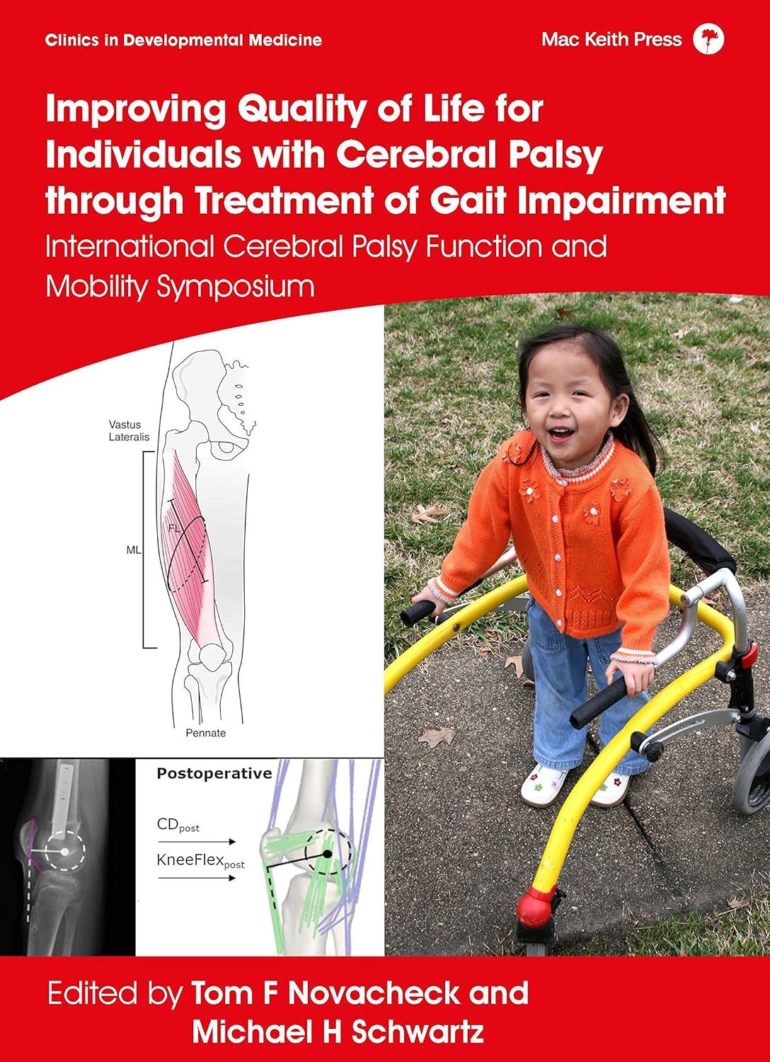 Improving Quality of Life for Individuals with Cerebral Palsy through treatment of Gait Impairment: International Cerebral Palsy Function and Mobility Symposium (Clinics in Developmental Medicine)