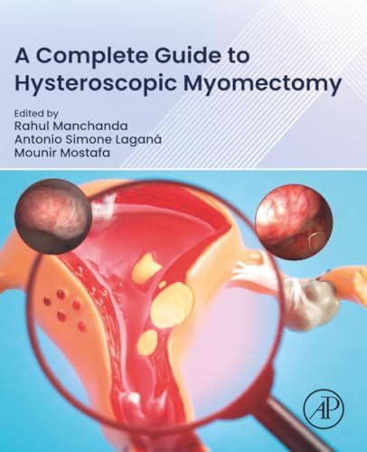 A Complete Guide to Hysteroscopic Myomectomy