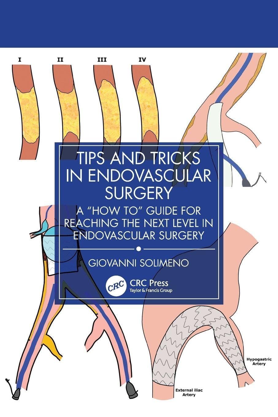 Tips &amp; Tricks in Endovascular Surgery