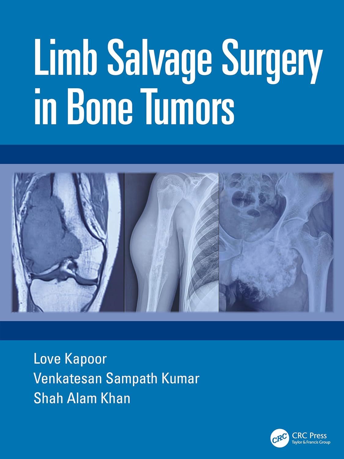 Limb Salvage Surgery in Bone Tumors (Original PDF from Publisher)