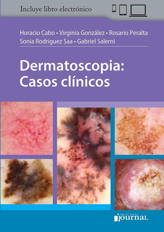 Dermatoscopia: Casos clínicos (Spanish Edition)