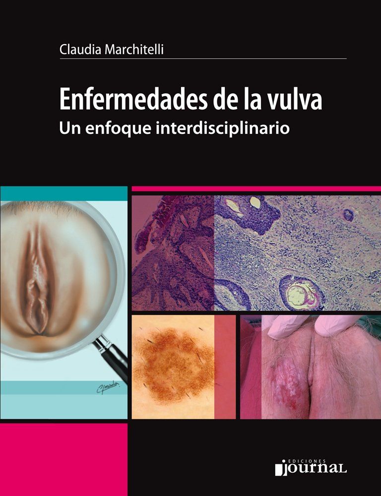 Enfermedades de la vulva- un enfoque interdisciplinario