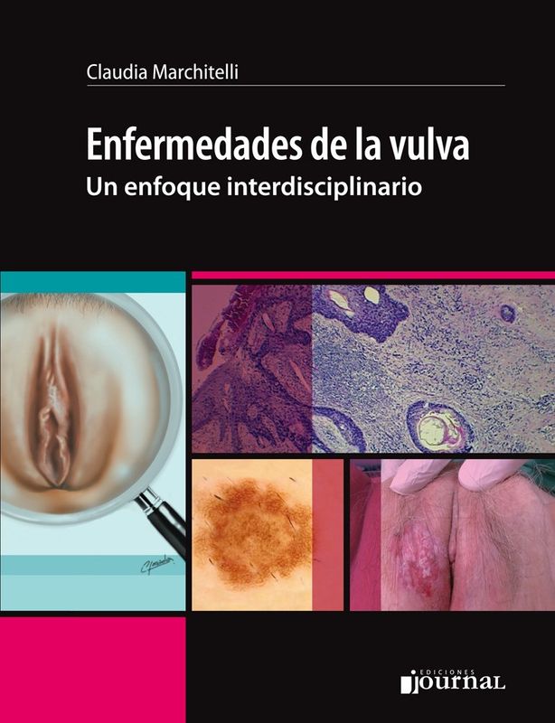 Enfermedades de la vulva- un enfoque interdisciplinario