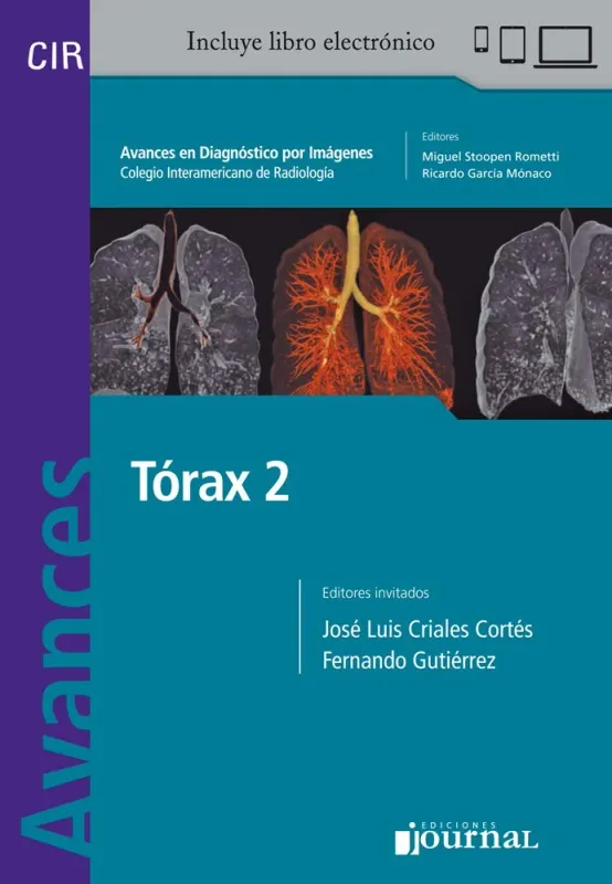 Avances en Diagnóstico por Imágenes: Tórax 2 (Spanish Edition)