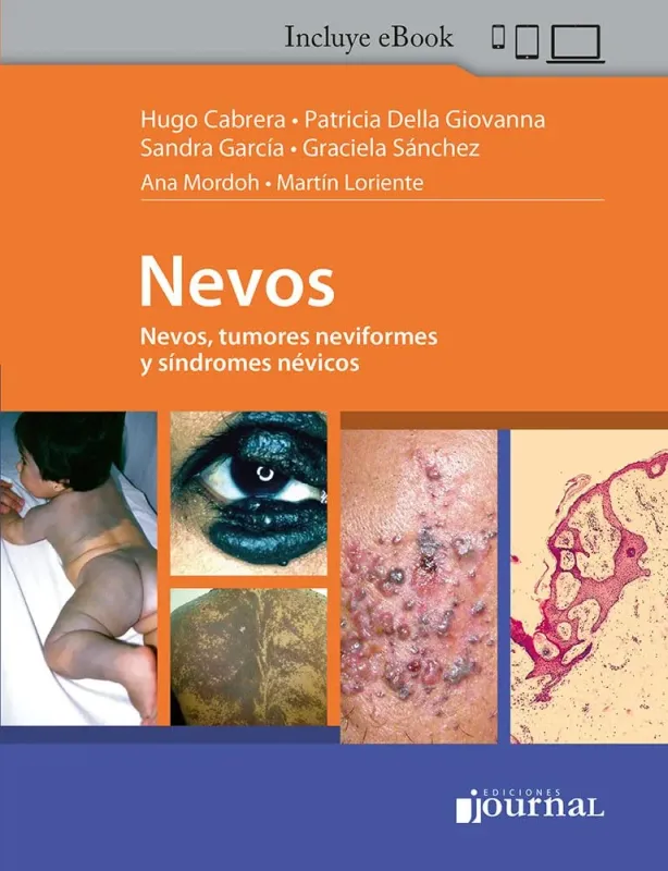 Nevos, Tumores Neviformes y Síndromes Névicos