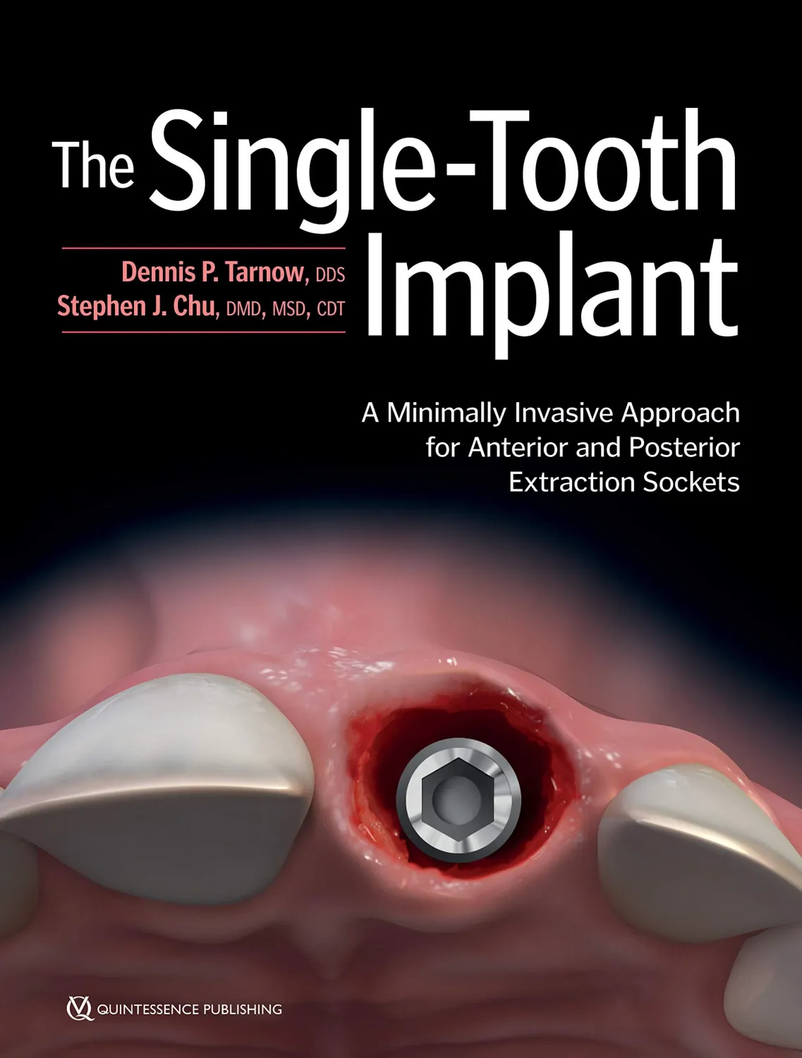 The Single-Tooth Implant:: A Minimally Invasive Approach for Anterior and Posterior Extraction Sockets