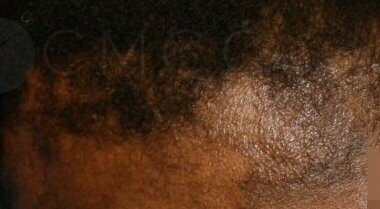 Conseils spécifiques chute des cheveux - alopécie