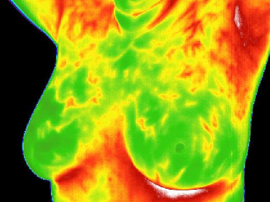 Thermography - Breast Screening