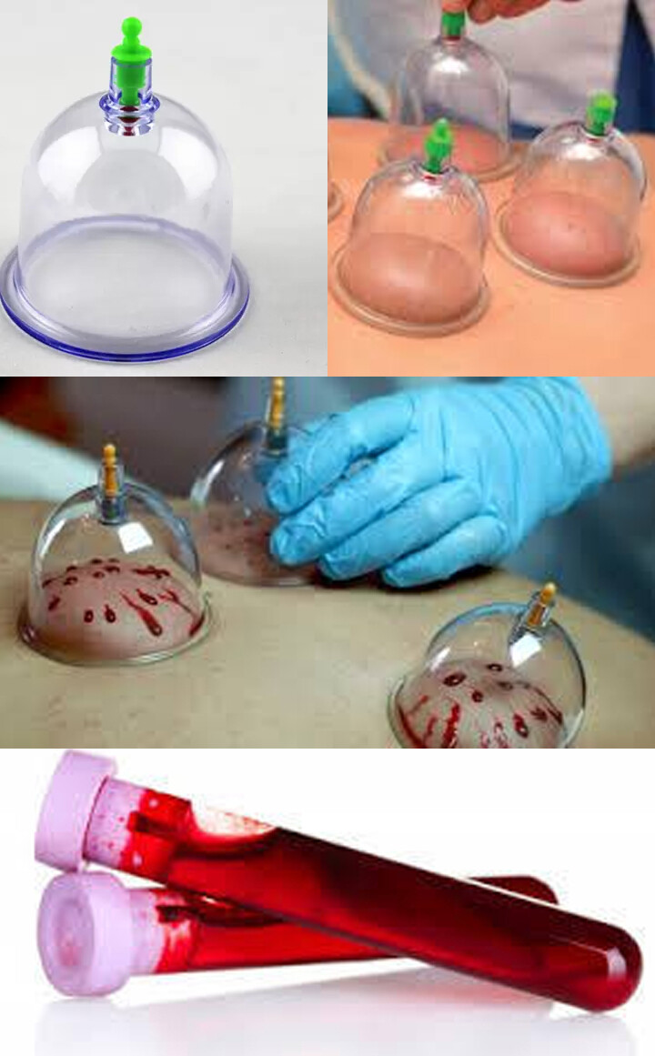 Hijama Therapy (cupping therapy) and Disposable Tubes for Blood Collection