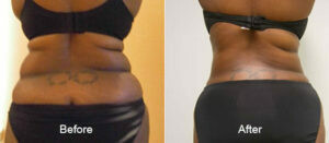 Cavitation