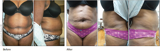 Body Contouring Treatment