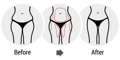 Cellulite Reduction