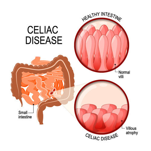 Comprehensive Celiac Disease Test Comprehensive Celiac Disease Test