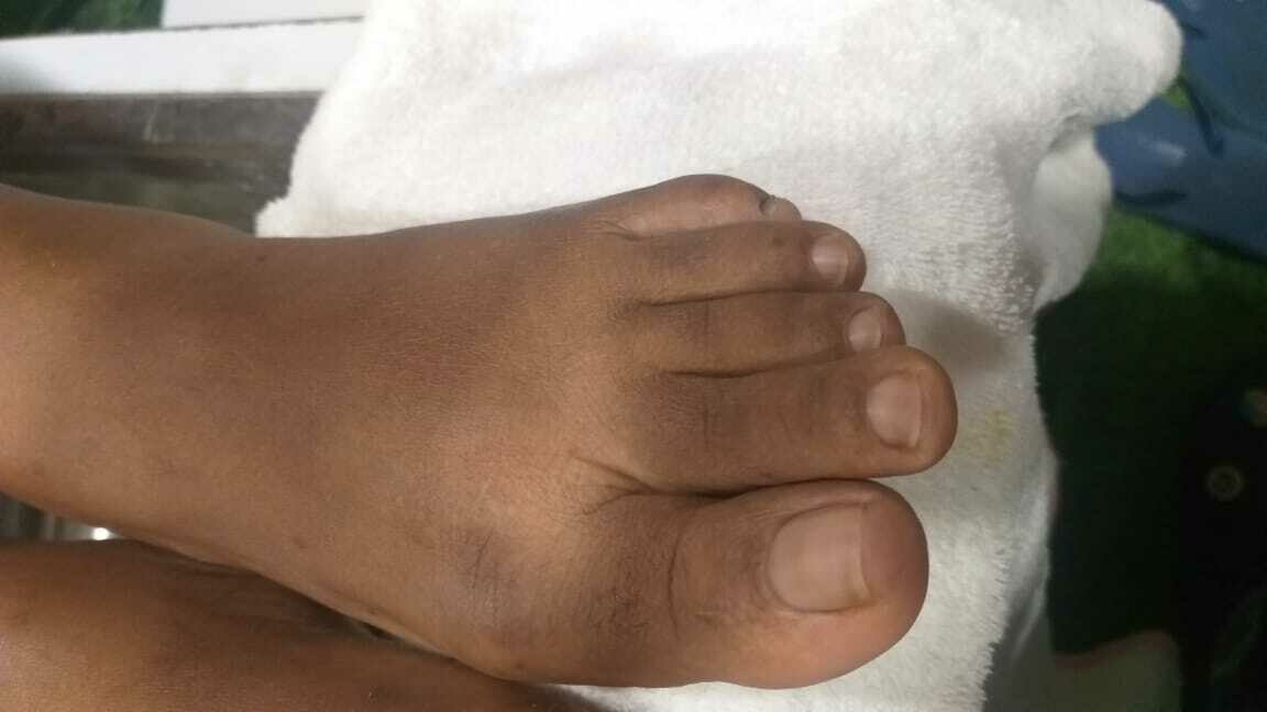Gel Polish Removal Toes