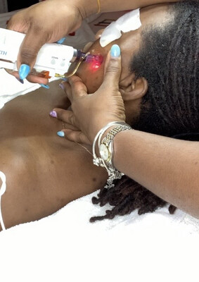 Microneedling Facial