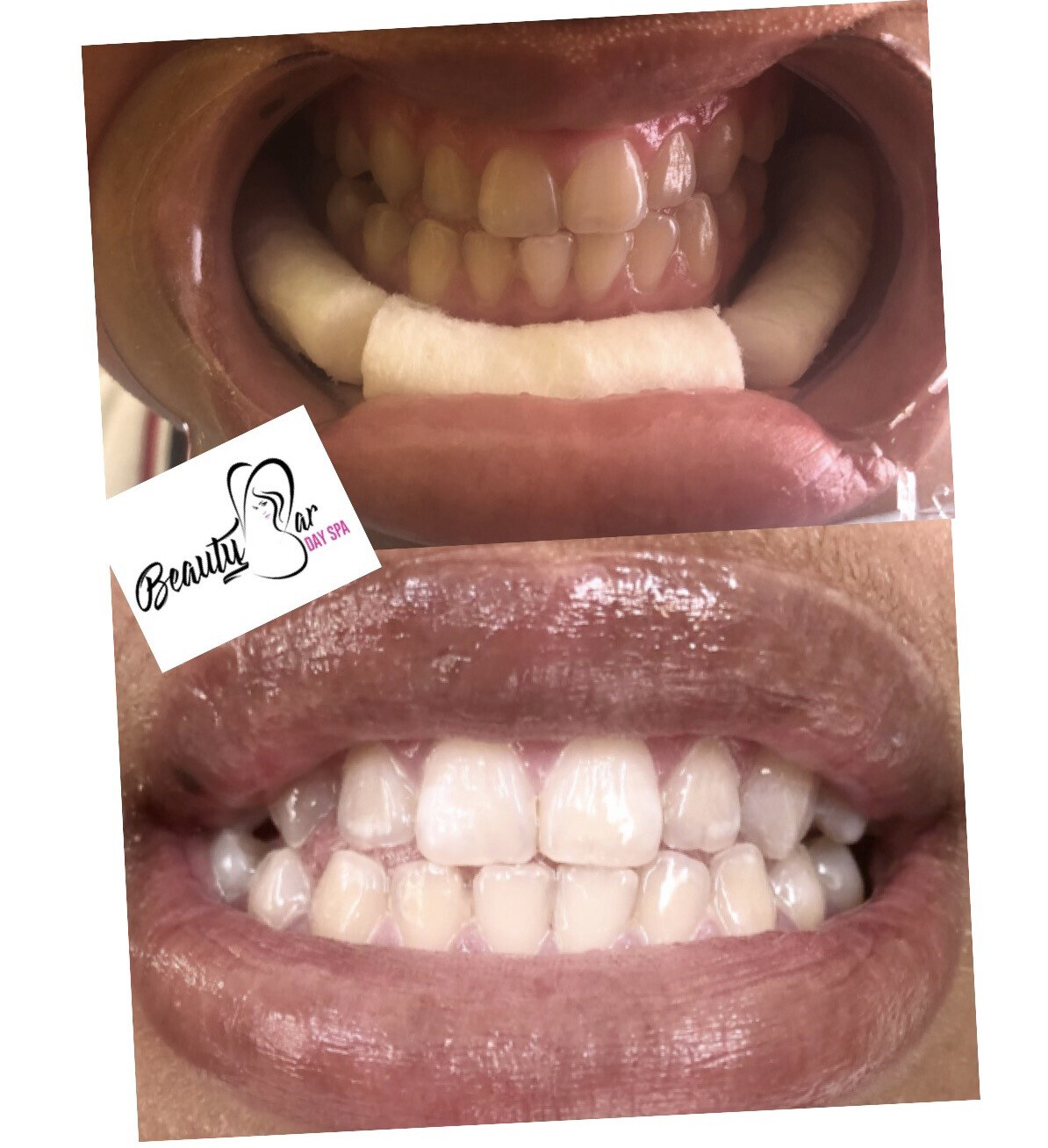 Teeth Whitening