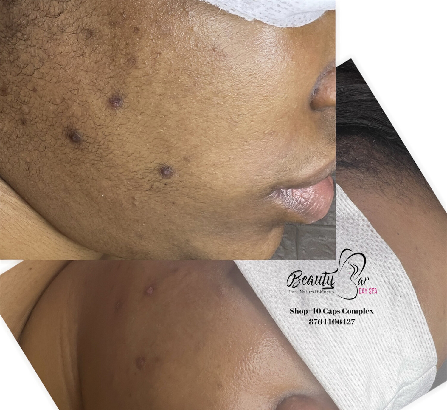 Dermaplaning Facial