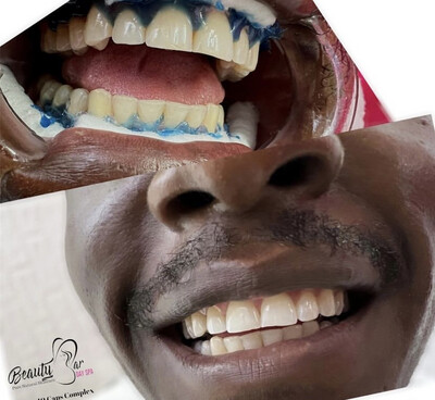 Teeth Whitening