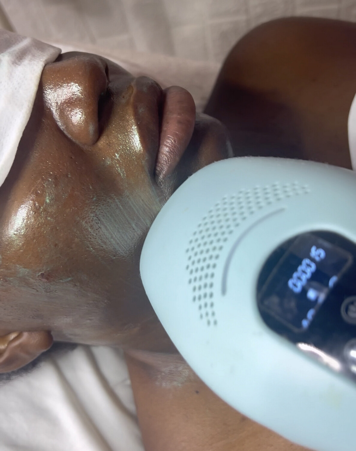 Acne Laser Facial