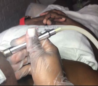 Microdermabrasion Facial