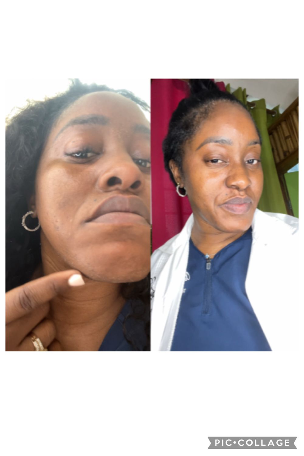 Chemical Peel (Level 1)